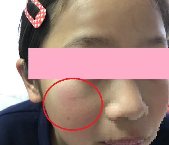 子供の顔の怪我